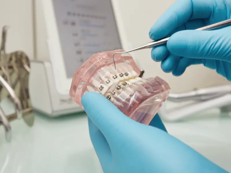 יישור שיניים בתל אביב